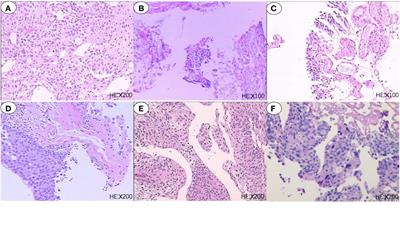 Case Report: Anlotinib Combined With Sintilimab as Third-Line Treatment in a Metastatic Urothelial Bladder Carcinoma Patient With FGFR3 Mutation